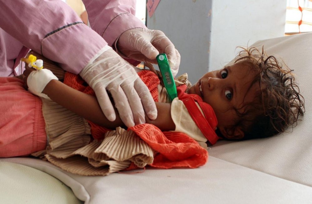 yemenichildwithcholerasanaa.afp_.thumb.jpg.ef413465639eabdb7999e821d6b15eaf.jpg
